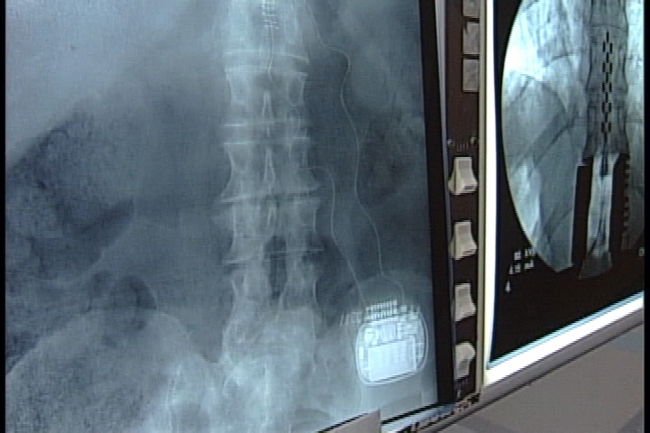Sensor implants providing relief for long term pain sufferers ...