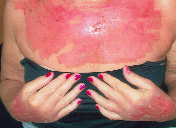 Woman warns of cosmetic laser treatment - image