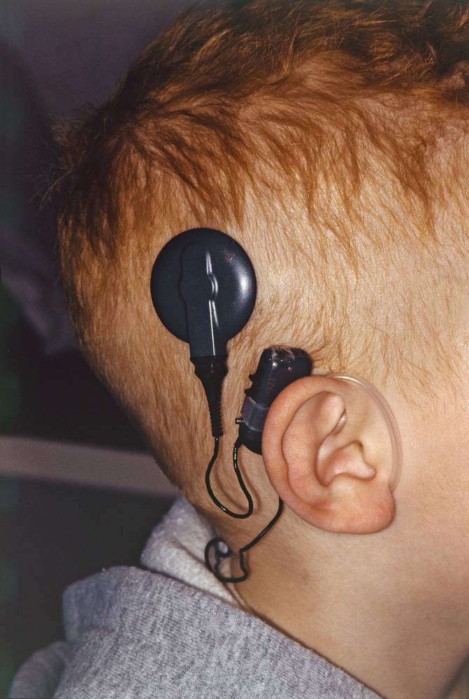 Ontario cuts wait time in half for people seeking to get cochlear implants - image
