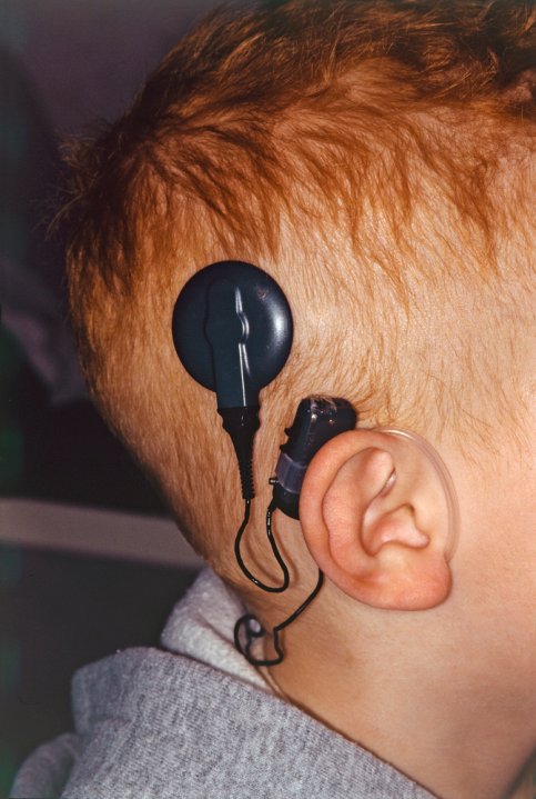 Ontario cuts wait time in half for people seeking to get cochlear ...