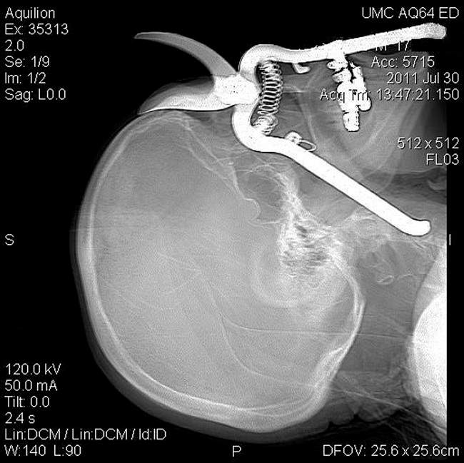 In this image provided by the University Medical Center in Tucson, a CT scan shows a pair of pruning shears embedded in the head of an 86-year-old Green Valley, Ariz., man before it was removed by Medical Center surgeons in Tucson on July 30, 2011. Leroy Luetscher was accidentally impaled through his eye socket after falling on the shears while working in his yard, the handle penetrating his eye socket and reaching down into his neck. He is expected to make a full recovery. (AP Photo/University Medical Center,Tucson, Arizona).