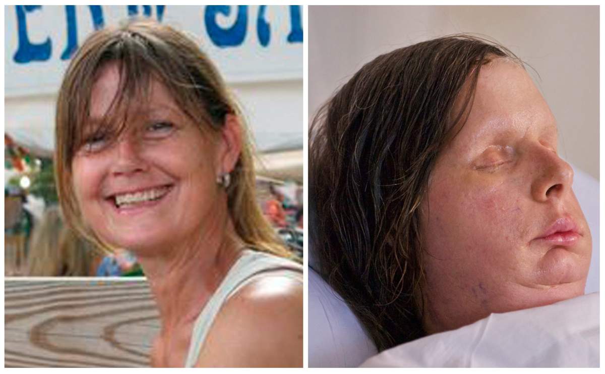 Chimp attack victim undergoes face transplant - image
