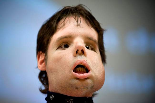 FILE - In this July 26, 2010 photo, Oscar, a man who underwent a full-face transplant in April, poses for the photographers as he appears in public for the first time in a news conference at the Vall d'Hebron Hospital in Barcelona, Spain, More face transplant recipients and donor families are going public. They are boosting acceptance of an operation that six years ago was just daredevil theory. (AP Photo/David Ramos).