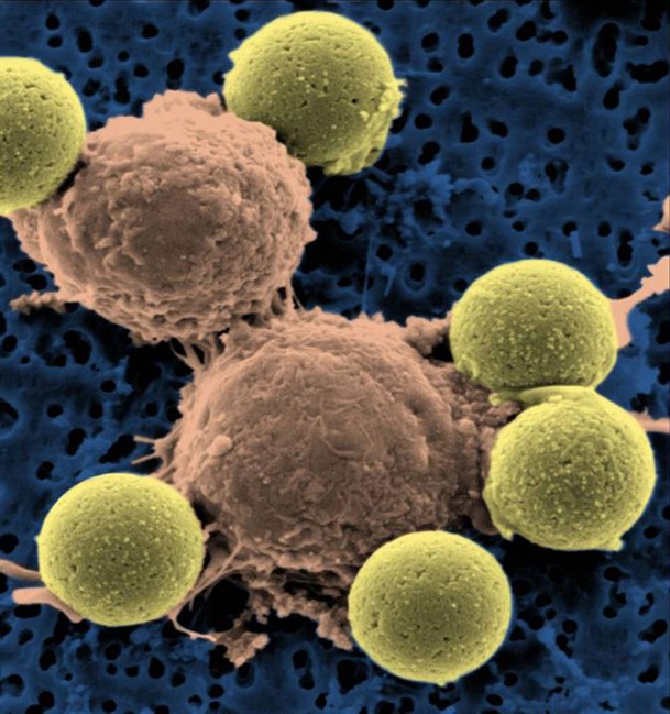 This microscopy image provided by Dr. Carl June on Wednesday, Aug. 10, 2011 shows immune system T-cells, center, binding to beads which cause the cells to divide. The beads, depicted in yellow, are later removed, leaving pure T-cells which are then ready for infusion to the cancer patients. Scientists are reporting the first clear success with gene therapy to treat leukemia, using the patients' own blood cells to hunt down and wipe out their cancer.  (AP Photo/Dr. Carl June).
