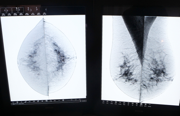Images provided by a mammogram.


