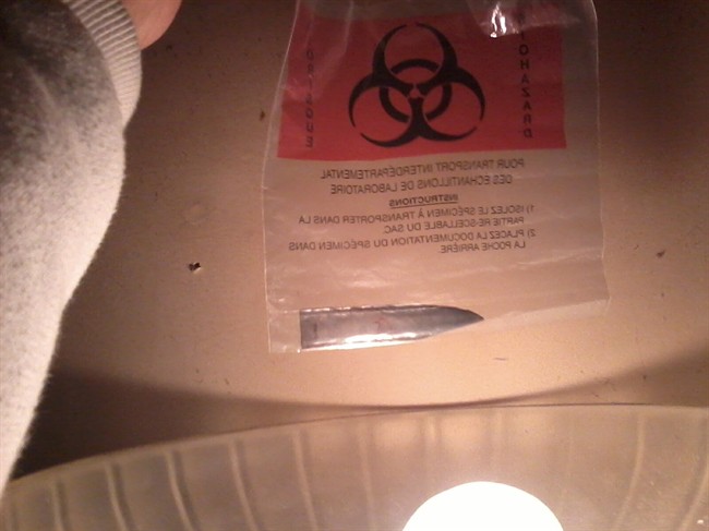 NWT man finds knife in back after 3 years - image