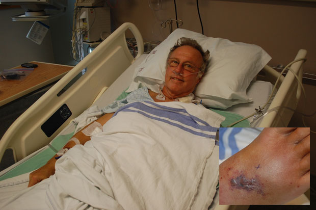 61-year-old Michael Lovatt who was bitten by a snake in Costa Rica, is pictured recovering at Vancouver General Hospital. Inset photo: snake bit on foot .