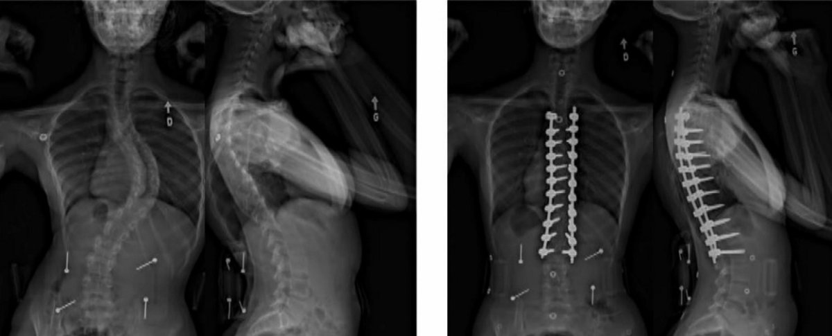 X-ray slide of scoliosis. Before operation (left) After operation (right) .