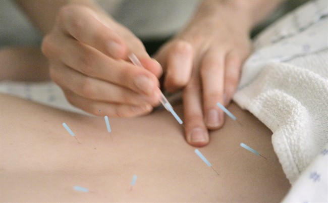 Acupuncture needles.