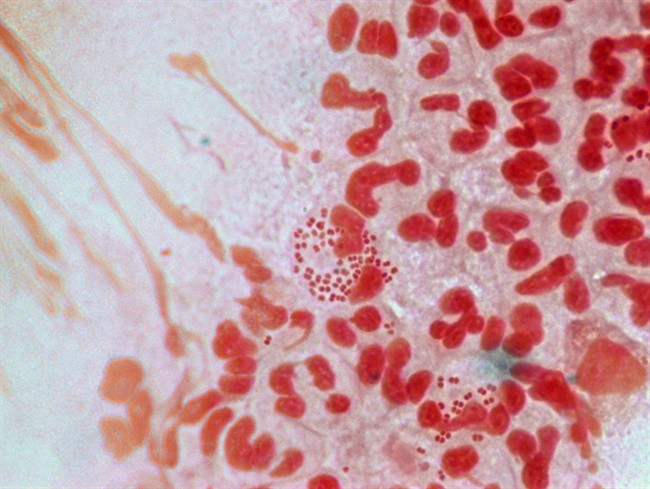 Untreatable ‘superbug’ Gonorrhea Found In 3 Patients: WHO - National ...