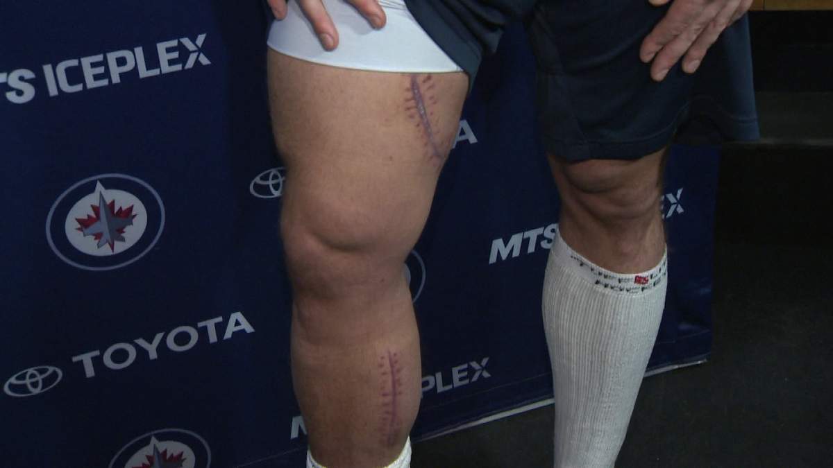 Jets defenceman Zach Redmond shows off the scars from a horrific injury he suffered in late February.