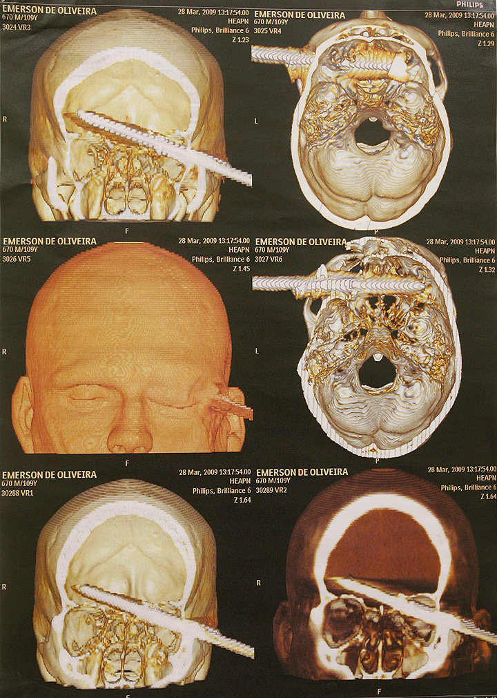 The CAT scan of Emerson de Oliveira Abreu, a man who came to the hospital with a spear stuck in his head after a diving accident, is shown on a monitor at the Adao Pereira Nunes state hospital in Duque de Caxias, Brazil, Wednesday, April 1, 2009.