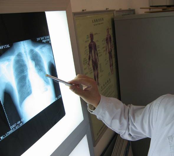 A doctor examines an X-ray of a patient's lungs. Exposure to radon is the second leading cause of lung cancer in Canada.