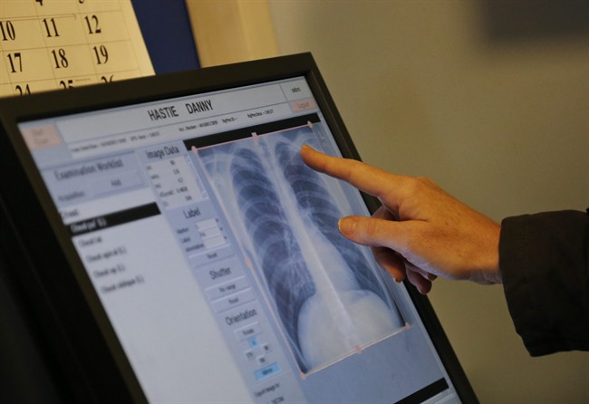 File photo: A radiographer reads an X-ray that came negative for tuberculosis.