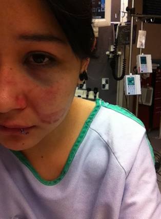 Harmonie David showing some of her injuries after the accident. Submitted photo.