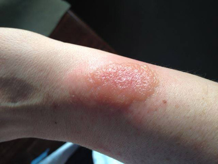 Toronto-area woman recovering from chemical burn allegedly caused by FitBit Force Globalnews.ca