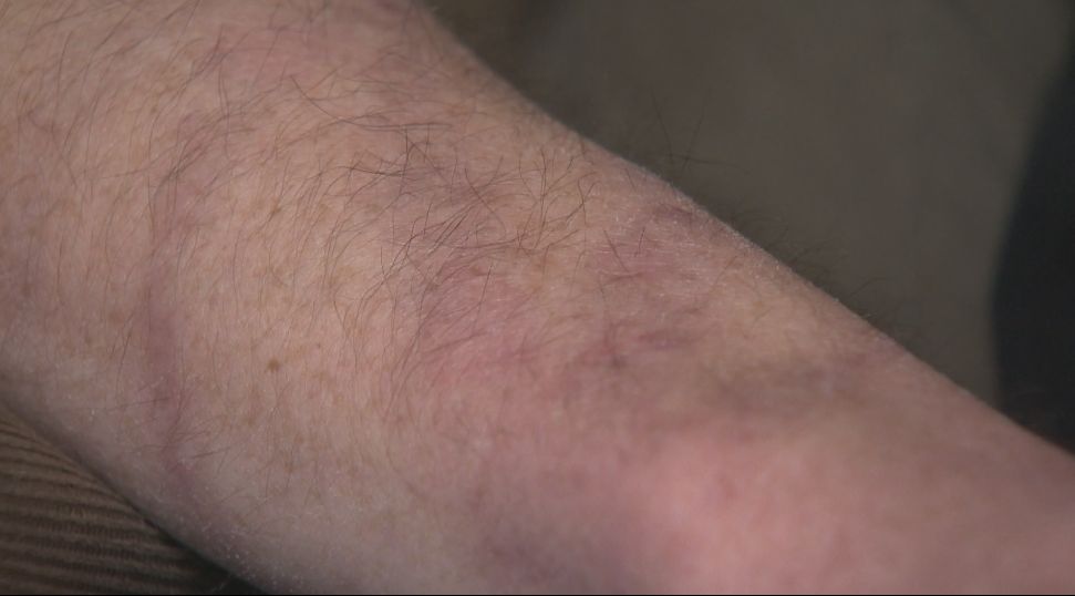 One man’s painful temporary tattoo experience has him warning others - image