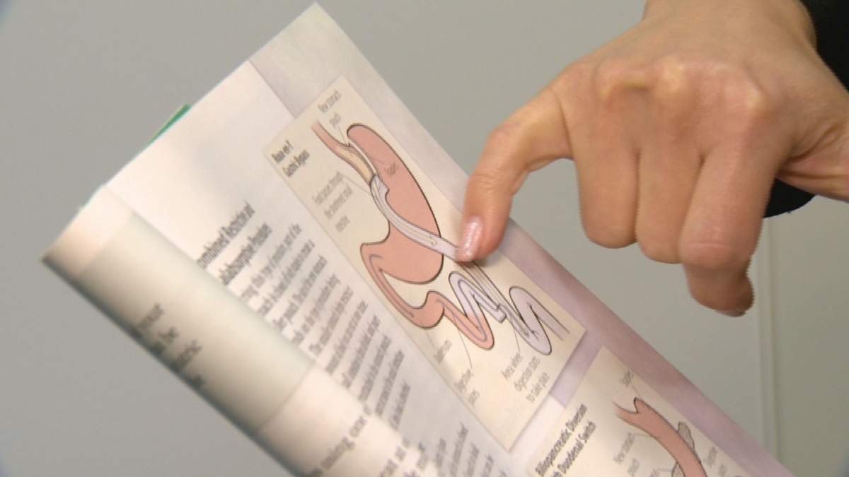 The number of bariatric surgeries in Saskatchewan has quadrupled.