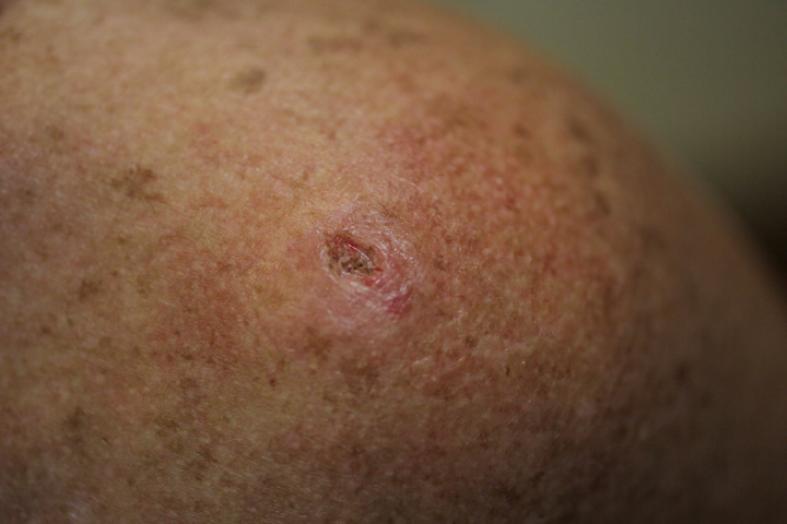 Melanoma skin cancer is one of the fastest-rising cancers in Canada.