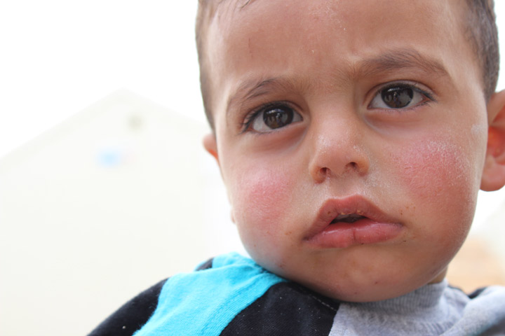 A baby with a rash in Azraq Camp
