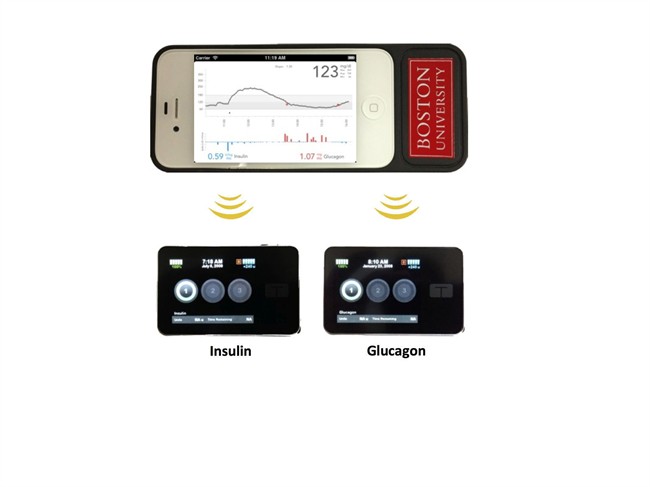 This undated product image provided Boston University Department of Biomedical Engineering shows the bionic pancreas developed by a Boston University/Massachusetts General Hospital research team. The bionic pancreas consists of a smartphone, top, hardwired to a continuous glucose monitor and two pumps, bottom, that pumps deliver doses of insulin or glucagon every five minutes. 