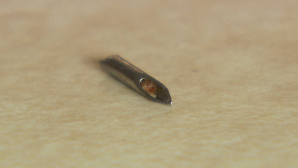 This needle was found in a Calgary boy's hamburger.