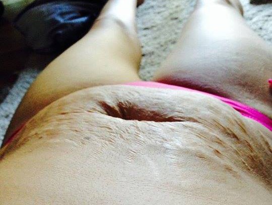 shamed for her stretch marks