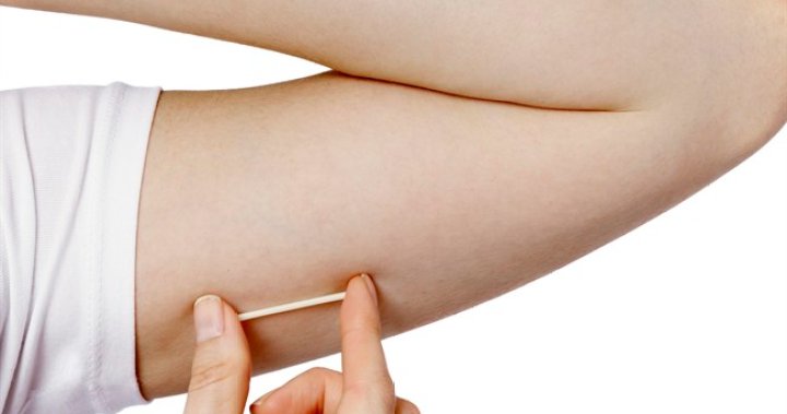 Health Canada approves birth control arm implant Nexplanon - National