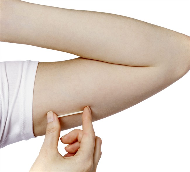FILE - In this undated file image provided by Merck, a model holds the Nexplanon hormonal implant for birth control. 