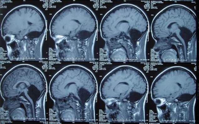 The brain