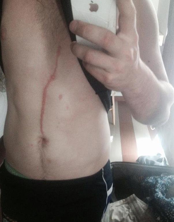 The mark left by the spider started near Dylan Thomas’ belly button and continued up to his pectoral muscles.