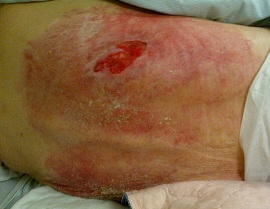 Margaret Warholm was suffering from a large bed sore when she was admitted to hospital in October 2013.