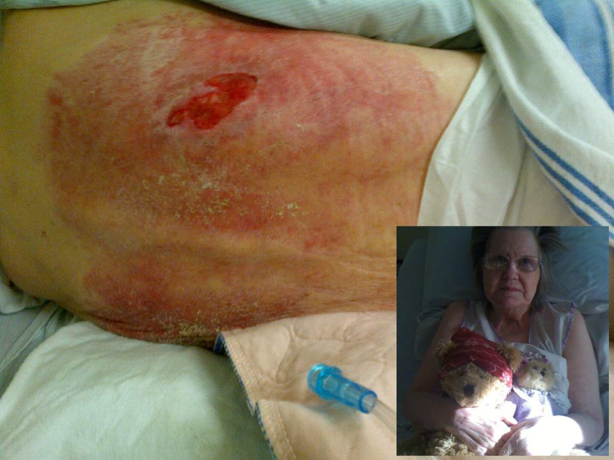 A Saskatchewan family is calling for minimum care requirements in senior care homes after they say their 74-year-old mother became malnourished, developed large bedsores, and was otherwise neglected while staying in a Regina residence.