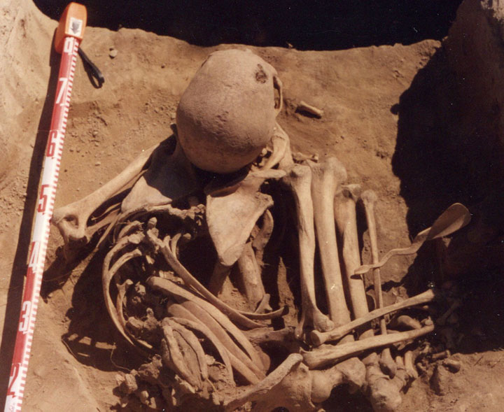 Saskatchewan scientist finds ancient cancer in man who died 4,500 years ago.