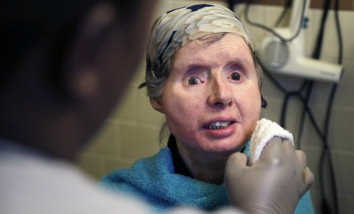 In this Friday, Feb. 20, 2015 photograph, Charla Nash smiles as her care worker washes her face at her apartment in Boston.  The Department of Defense is following Nash's progress, after funding her transplant surgery in 2011. Nash lost her face, eyes and hands after being mauled by a chimpanzee in 2009.