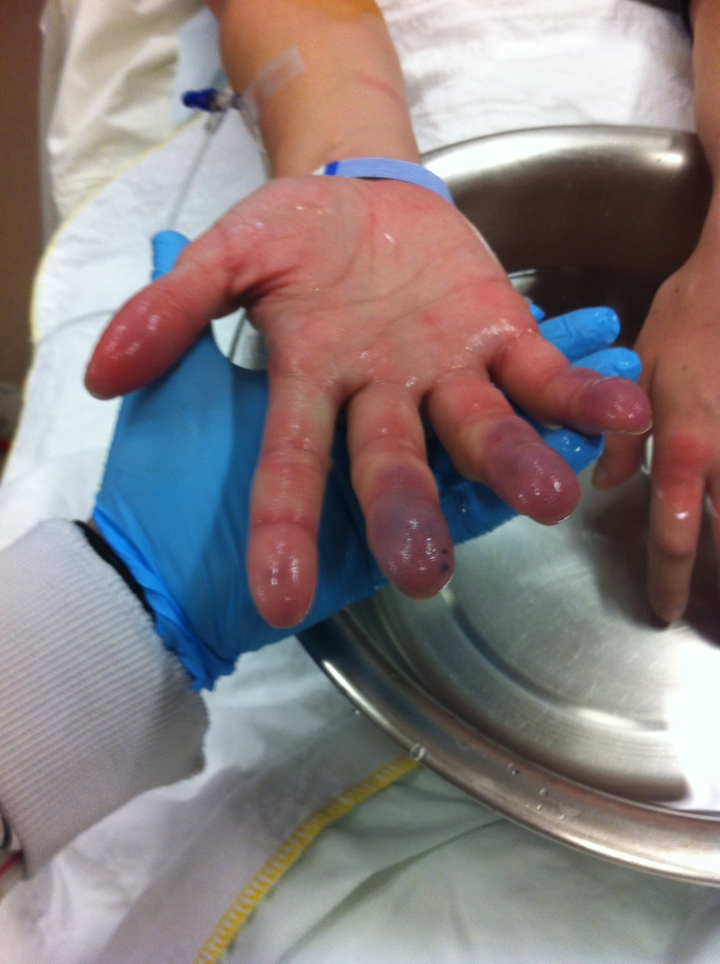 Australian Emma Quirk documented the painful experience of severe frostbite.