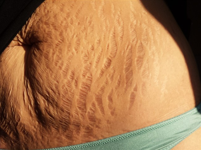 Love Your Lines stretch marks go viral in support of women