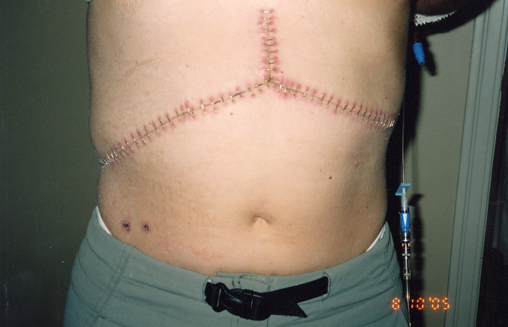 Sandy Rozecki had 63 staples and a large scar following her liver transplant.