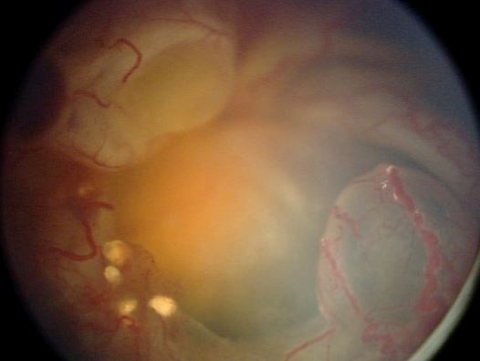 How looking over photos of your child could save their eyesight - image