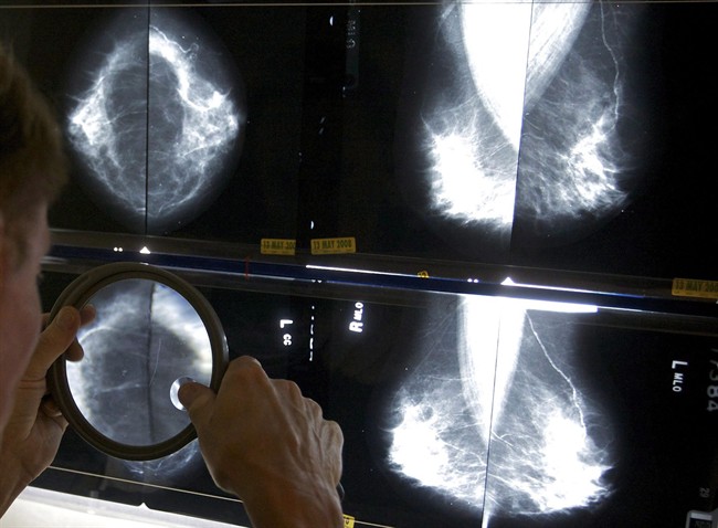A radiologist uses a magnifying glass to check mammograms for breast cancer in Los Angeles, May 6, 2010. 