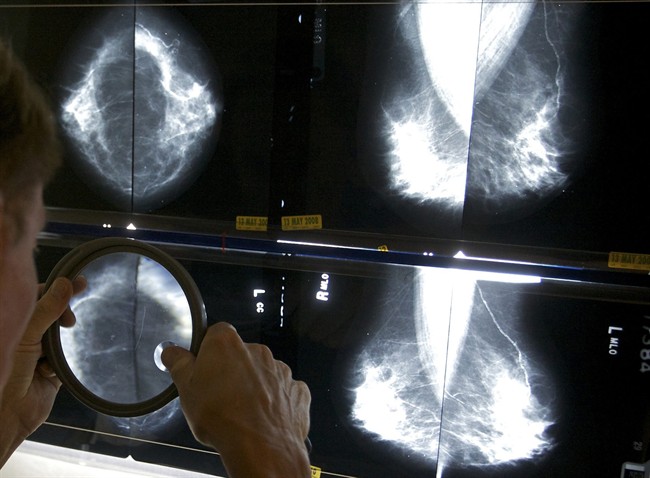 Thousands of breast cancer screenings in Hamilton and area skipped amid COVID pandemic - image