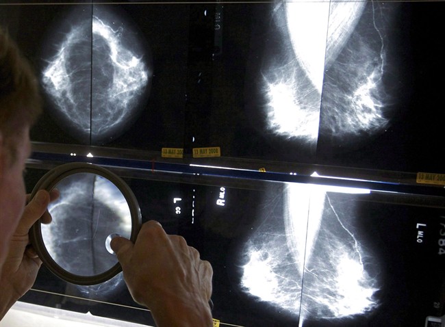 A radiologist uses a magnifying glass to check mammograms for breast cancer. 