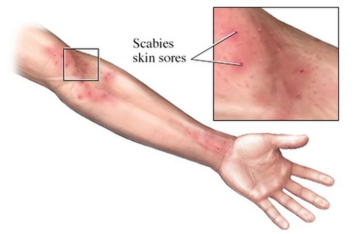 Scabies