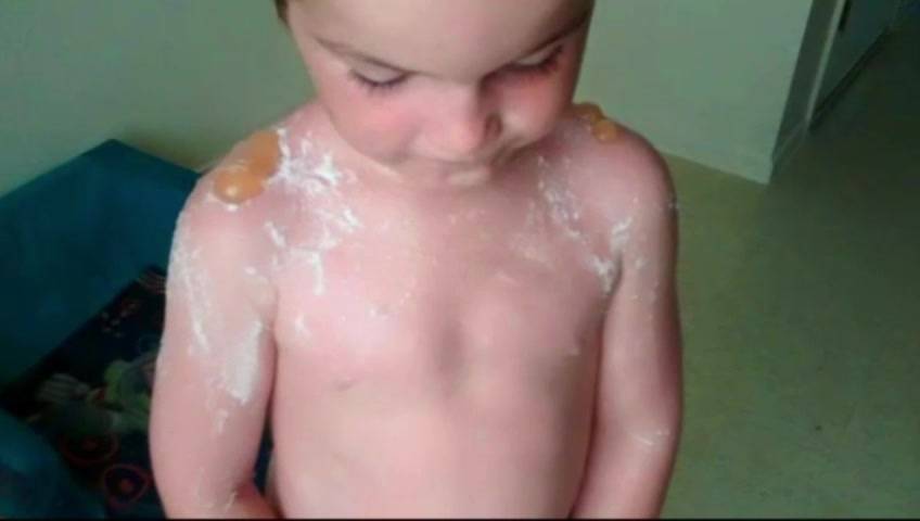 Boys who suffered horrific sunburns were in the sun less than 2 hours - image