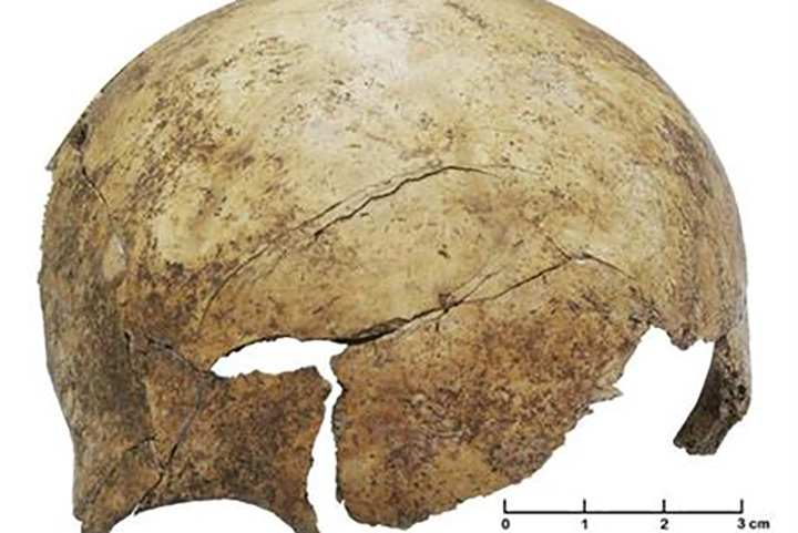 The fractured skull of an about eight-years-old child. The perimortem cranial injury in the frontal bone of the child that lived in the Stone Age was found on skeletal remains in a grave near Frankfurt, Germany, that bear signs of terrible violence some 7,000 years ago, rare evidence, scientists say, of a massacre among Europe’s prehistoric people.