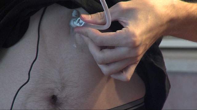 Utah man has rare disorder that makes him allergic to food - image
