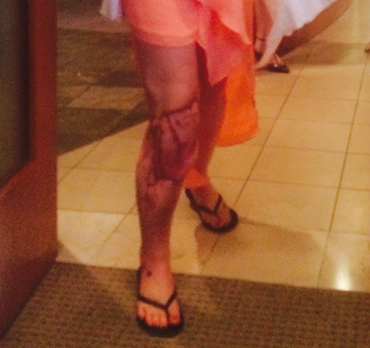 A close up pf the injury on Mallory Wild’s leg visible on Sept. 2, 2015.