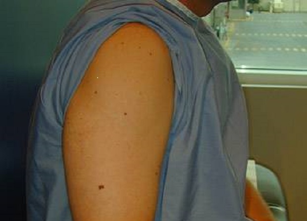 Check those moles on your right arm, they could predict your skin cancer risk: study - image