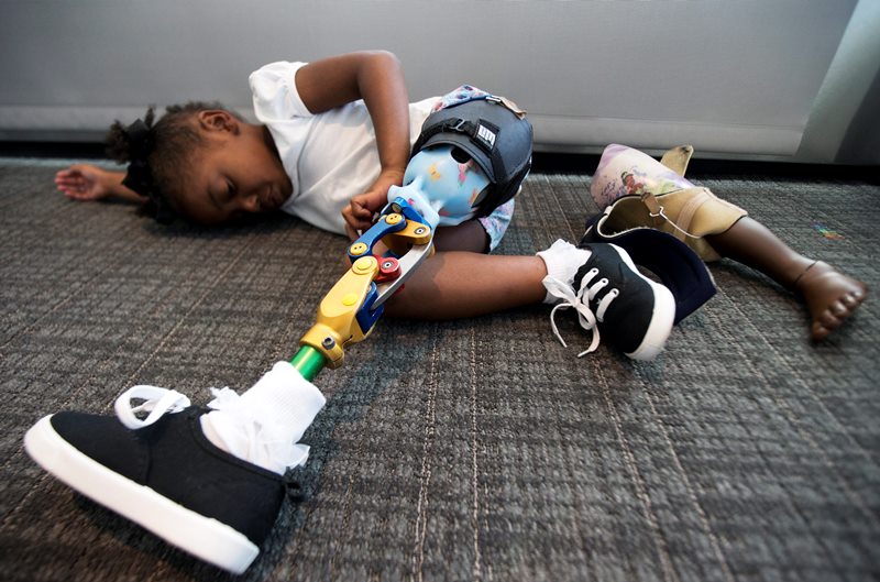 Miyah Williams, 3, wearing her prosthetic leg, rests in Washington, Friday, Oct. 23, 2015, at a meeting on the need for new pediatric medical devices hosted by Children’s National Health System. Miyah struggled with a painful and hard-to-move socket attaching her prosthesis until last August, when she received a new softer and more flexible kind. Miyah’s old prosthesis lays on the floor.