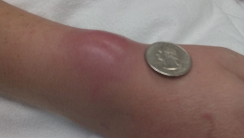Woman needs surgery after hair tie on her wrist leads to infection - image